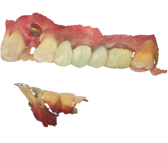 3d printing dental Crowns