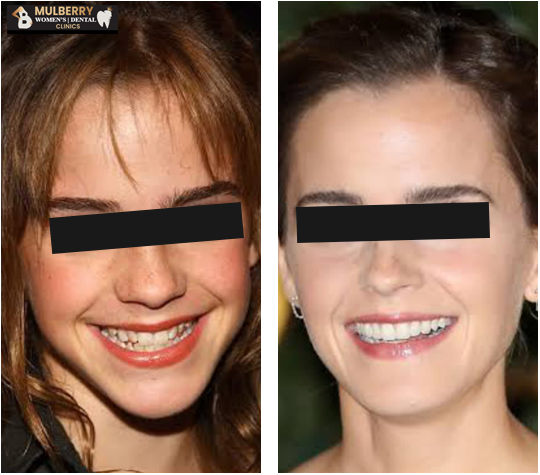 Celebrity Smile Makeover