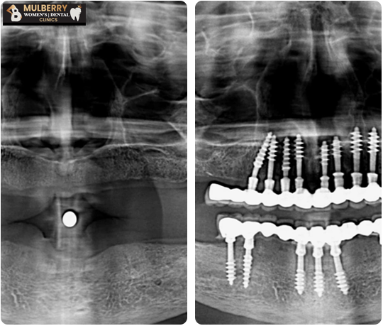 Advanced Dental Implants