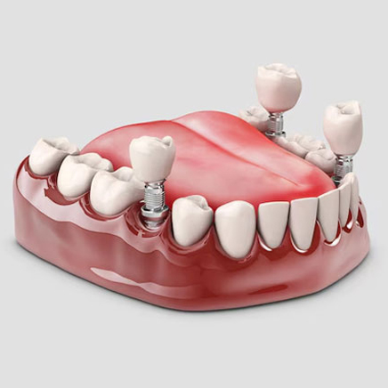 Dental Implants Expert Treatment