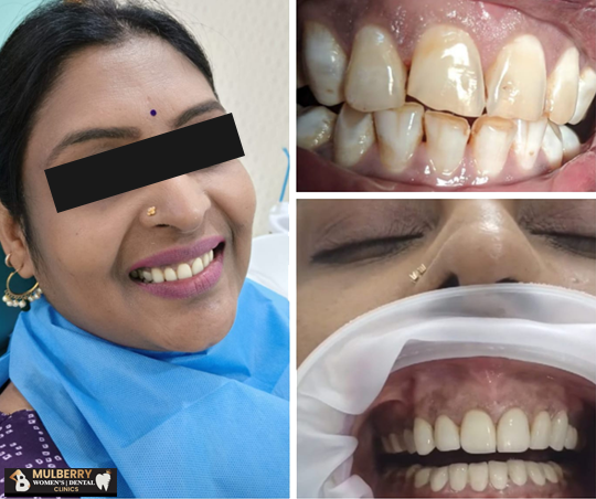 Veneer Specialist in Hyderabad