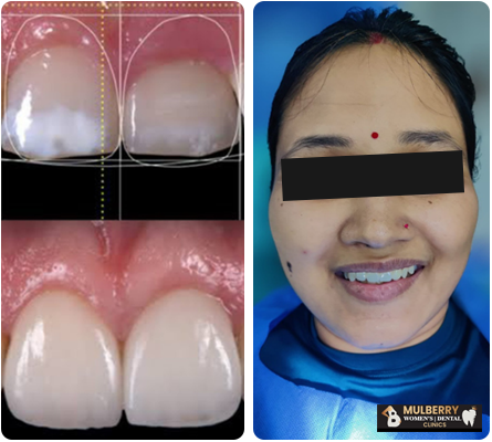 Dental Veneer Treatment in Hyderabad