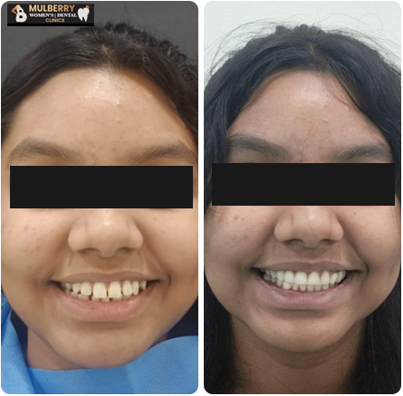 Invisalign Braces Maintenance