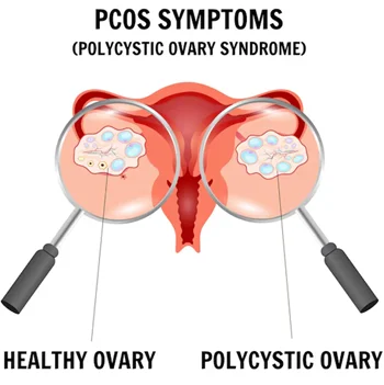 Polycystic Ovary Syndrome