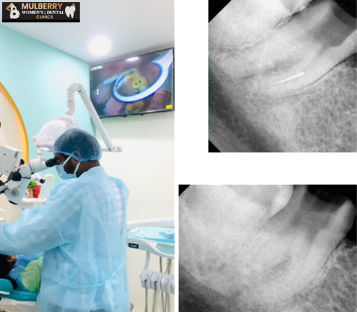 Root Canal Treatment in Hyderabad