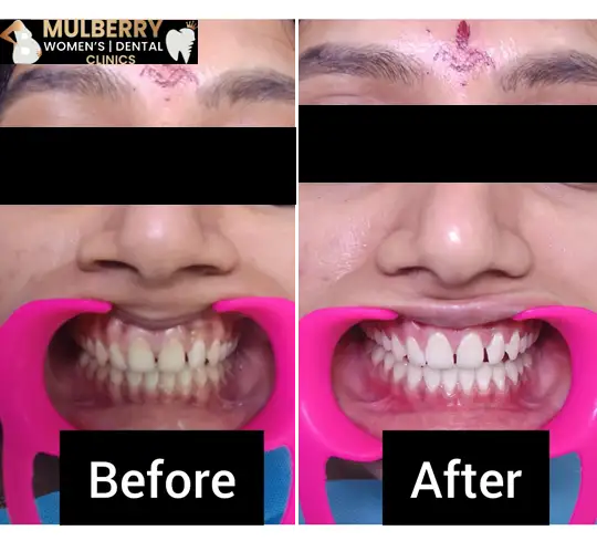 Teeth Whitening Treatment in Hyderabad