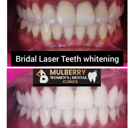 Advanced Teeth Whitening