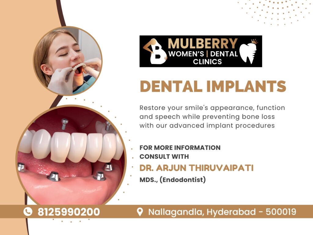 Dental Implants