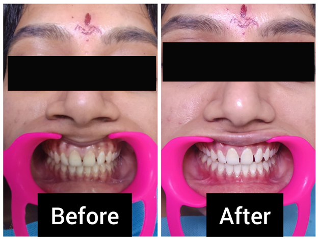 Bridal Teeth Whitening Treatment