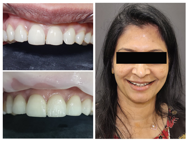 3d-printed-veneers